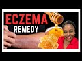 Eczema Rash Treatment