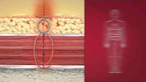 Plus Sutures How it works Video