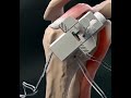 Shoulder replacement shoulder replacement surgery 3danimation education