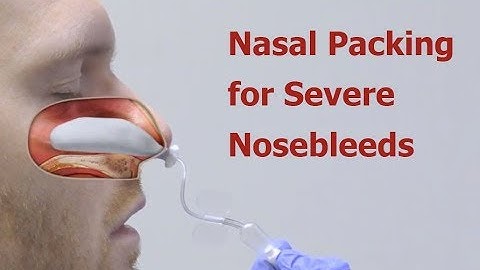 Nasal Packing for Severe Nosebleeds