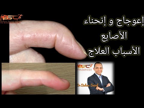 اعوجاج و انحناء الأصابع خشونة ام روماتويد ام