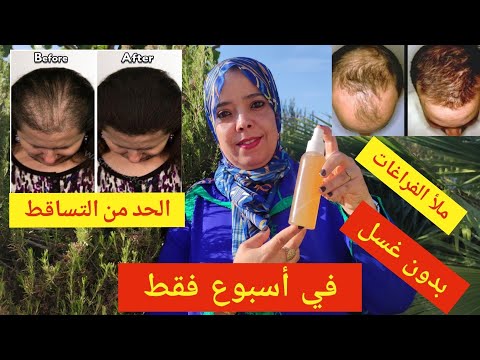 منع تساقط الشعر وزيادة كثافته وملأ الفراغات بمكونات طبيعية وبدون غسل خلال أسبوع فقط للرجال والنساء
