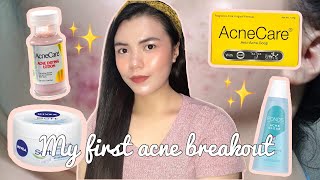 HOW I CLEARED MY SKIN✨ (ACNE JOURNEY & SKINCARE THAT I USED) | Erica Empleo screenshot 4