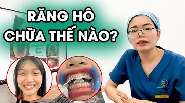 Gắn mắc cài điều trị răng hô, khớp cắn chìa