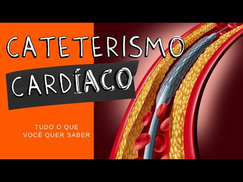 Vídeo: Cateterismo Cardíaco: Usos, Estágios E Fatores De Risco