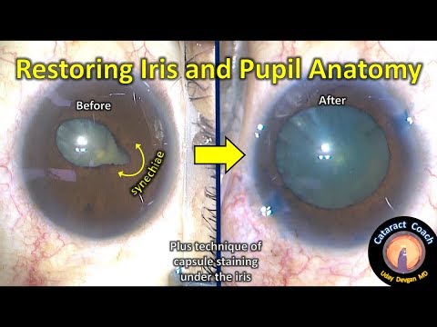 Lysis of Synechiae to restore iris and pupil anatomy in cataract surgery