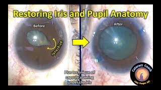 Lysis of Synechiae to restore iris and pupil anatomy in cataract surgery