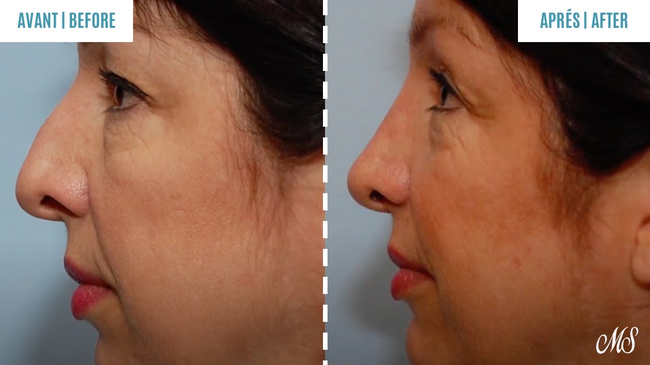 Rhinoplastie et augmentation du menton | Dr. Mark Samaha
