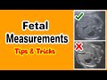 Fetal Measurements, Tips and Tricks