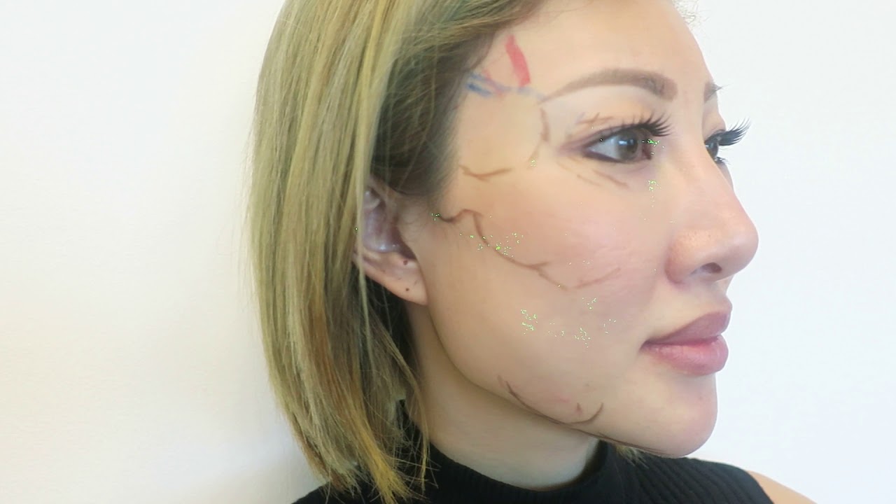 eyebrow lift singapore 105 