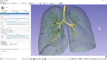 Airway segmentation in 3D Slicer with "Grow from Seeds"