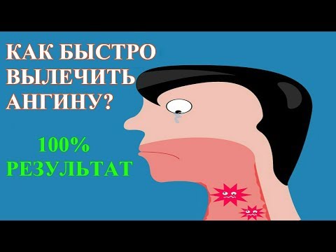 АНГИНА - как быстро ВЫЛЕЧИТЬ в домашних условиях? Симптомы, температура и антибиотики при ангине