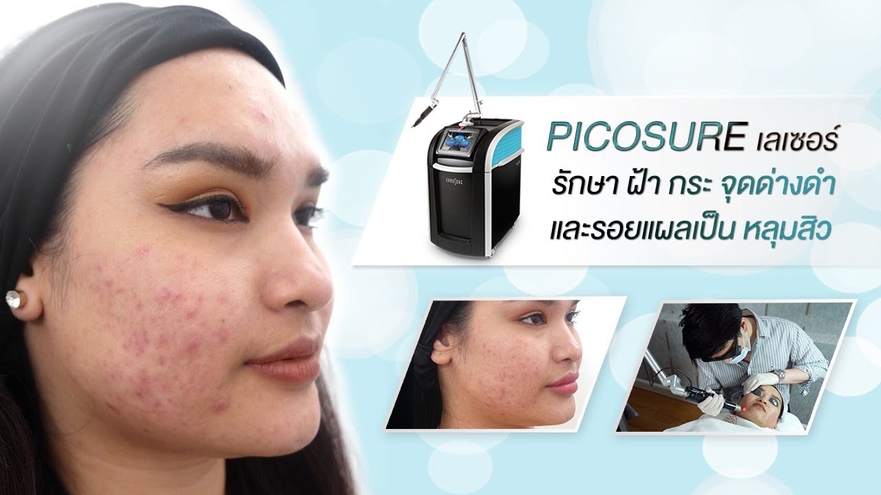 pico laser ที่ไหนดี รีวิวปัญหาฝ้ากระ คนไข้จริงเยอะที่สุด เลเซอร์โดยอาจารย์แพทย์