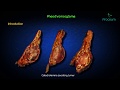 Pheochromocytoma usmle step 1 - Etiology , Pathogenesis , clinical features , treatment