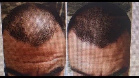 HeadStrong NY 3D Scalp Micropigmentation w/Chris Celebs, doctors