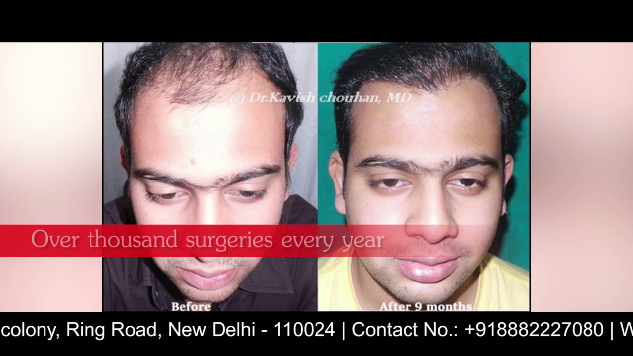 Hair Transplant Training in India - DermaClinix New Delhi - YouTube