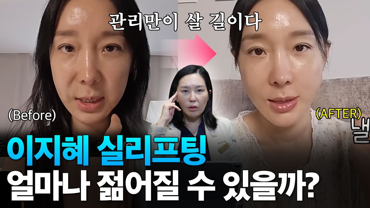 얼굴 작고 피부 얇은 분들 '이 시술' 함부로 하지 마세요! (이지혜 실리프팅 분석)