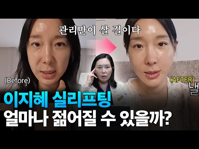 얼굴 작고 피부 얇은 분들 '이 시술' 함부로 하지 마세요! (이지혜 실리프팅 분석)
