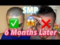 Scalp Micro Pigmentation (SMP) 6 Month Later! Update Video!
