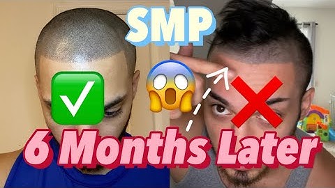 Scalp Micro Pigmentation (SMP) 6 Month Later! Update Video!