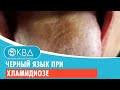 Черный язык при хламидиозе. Клинический случай №97