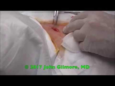 Dr  Gilmore's Mystery Procedure!   What Is It?