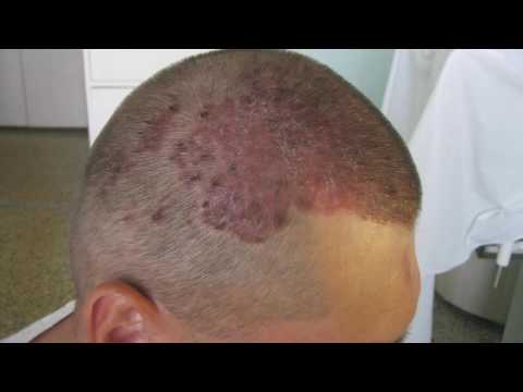 Почему болит кожа головы?