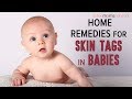 Baby Skin Tags Armpit