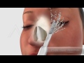 Video Endoscopic micro rhinoplasty - Grade III High Septal Deviation Animation by Yakup Avşar