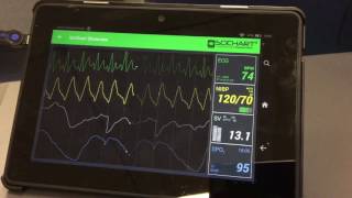 Realtime Android ECG / Medical Software using SciChart screenshot 4