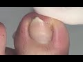 Two case of bad shape nail treatment