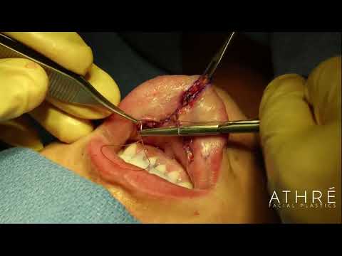 Enhance Your Smile: Surgical Lower Lip Lift Procedure Explained | Dr. Raghu Athre, MD FACS