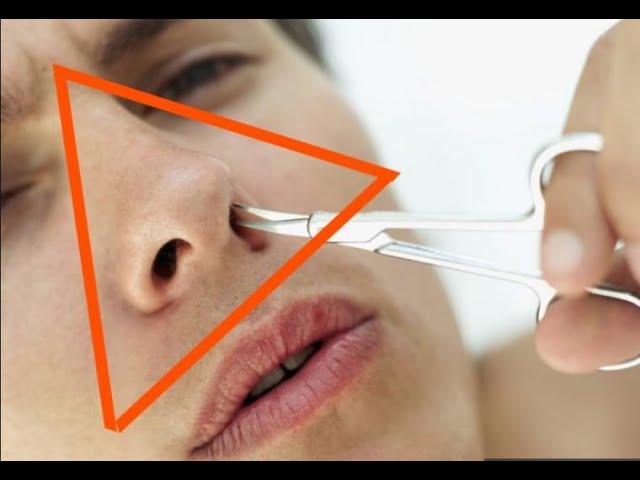 «Носогубный треугольник» на лице. Почему ни в коем случае нельзя трогать его руками