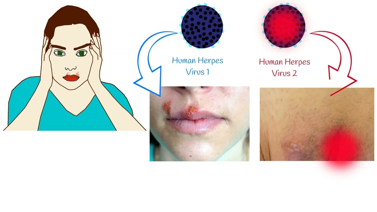 Oral Herpes and Genital Herpes pic picture