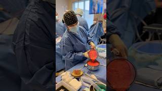 This Patient Is Undergoing Lipo 360 With Renuvion Skin Tightening To Achieve Her Sculpted Goals