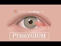 Pterygium eye surfers eye treatment causes and symptoms