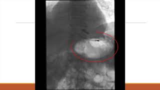 MSC Percutaneous Gastrostomy Tube Placement