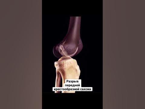 Разрыв передней крестообразной связки / Патология #анатомия #кт #мрт # ...
