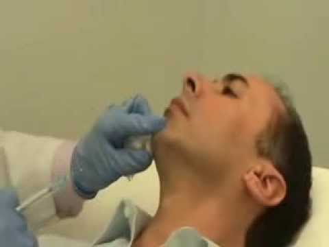 Non-Surgical Chin Augmentation with Radiesse by Doctor Yuriy Yagudin at Dermacare Medical PC. http://dermacaremedical.com Tel. (212) 223 2235.