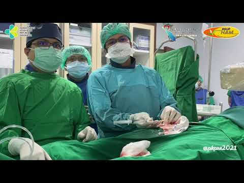 Video: R-gelombang Diselaraskan Pacing Atrium Pada Pesakit Kanak-kanak Dengan Tachycardia Ectopic Operasi Pasca Operasi: Selang Atrioventricular Disiasat Oleh Analisis Komputasi Dan Penil