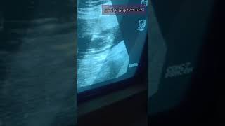 جنين ذكر بالسونار 3d فى الشهر الرابع سبحان الله