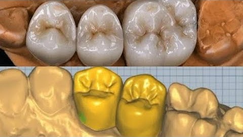 Ceramill Mind Design | Both Sides Anatomical Crowns #sajiddentallaboratory