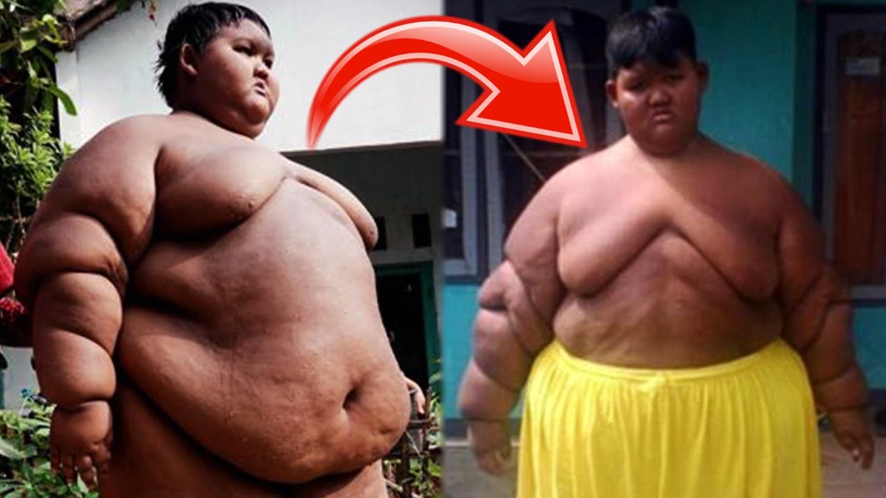 The World s Fattest Boy Has Lost 70lbs After Life Saving Surgery YouTube the-world-s-fattest-boy-has-lost-70lbs-after-life-saving-surgery-youtube