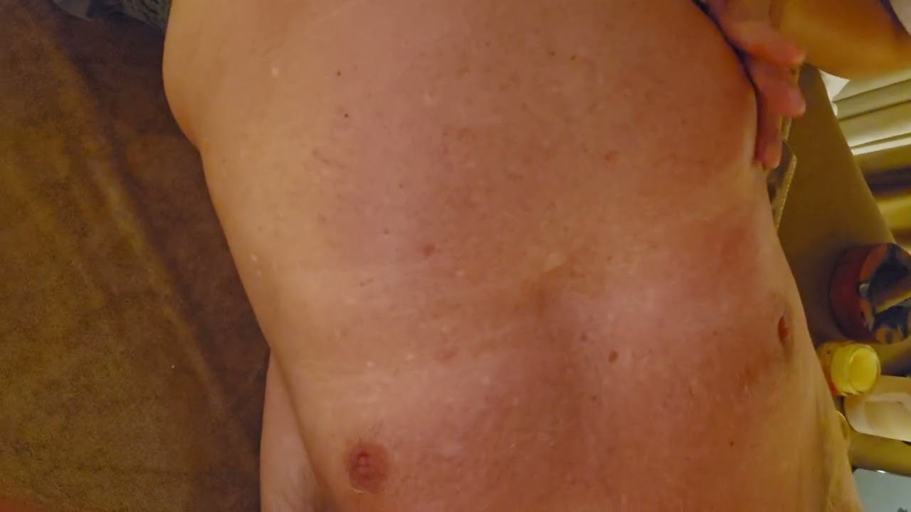 Feuer Schmerzbehandlung