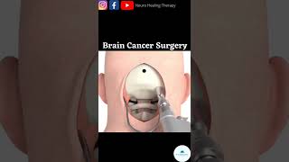Brain tumor/cancer surgery #shorts screenshot 4