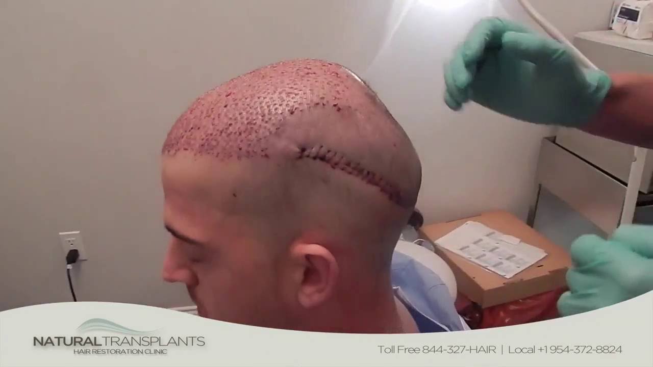 Cost Of Hair Transplant | Juno Beach Hair Clinic Near Me ...
