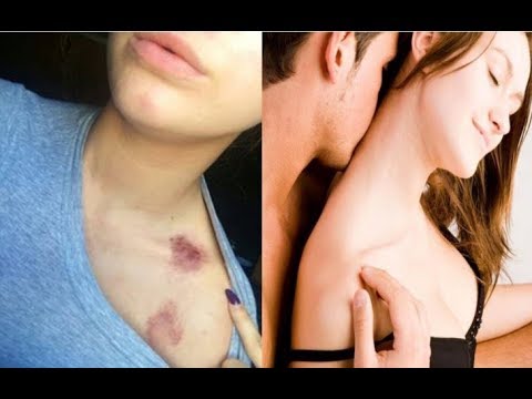 How To Give A Girl A Hickey