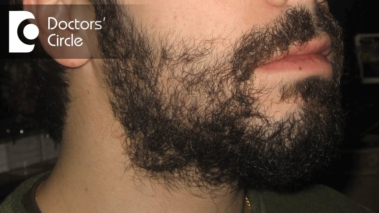 Cureus  Incipient Diabetes Mellitus and Nascent Thyroid Disease Presenting  as Beard Alopecia Areata Case Report and Treatment Review of Alopecia  Areata of the Beard  Article