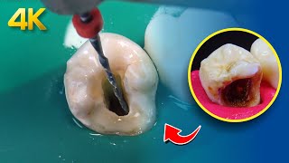 AMAZING process of root canal treatment and Onlay in 4k