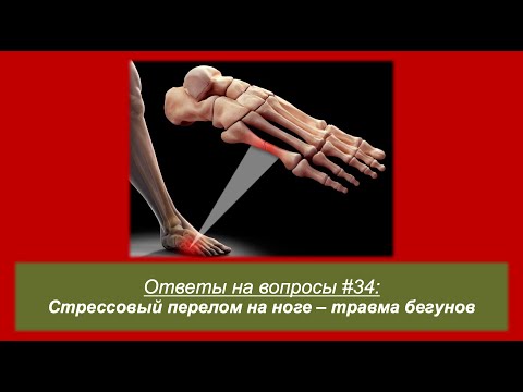 Стрессовый перелом на ноге - травма бегуна 🦴 🏃‍♂️ 🤕  Ответы на вопросы #34 | Pedro Vizuete